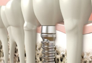Cabinet de stomatologie în Iași - Implant dentar